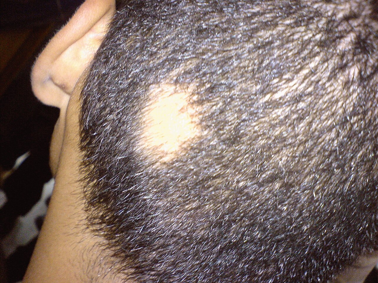 Cuero cabelludo con alopecia areata