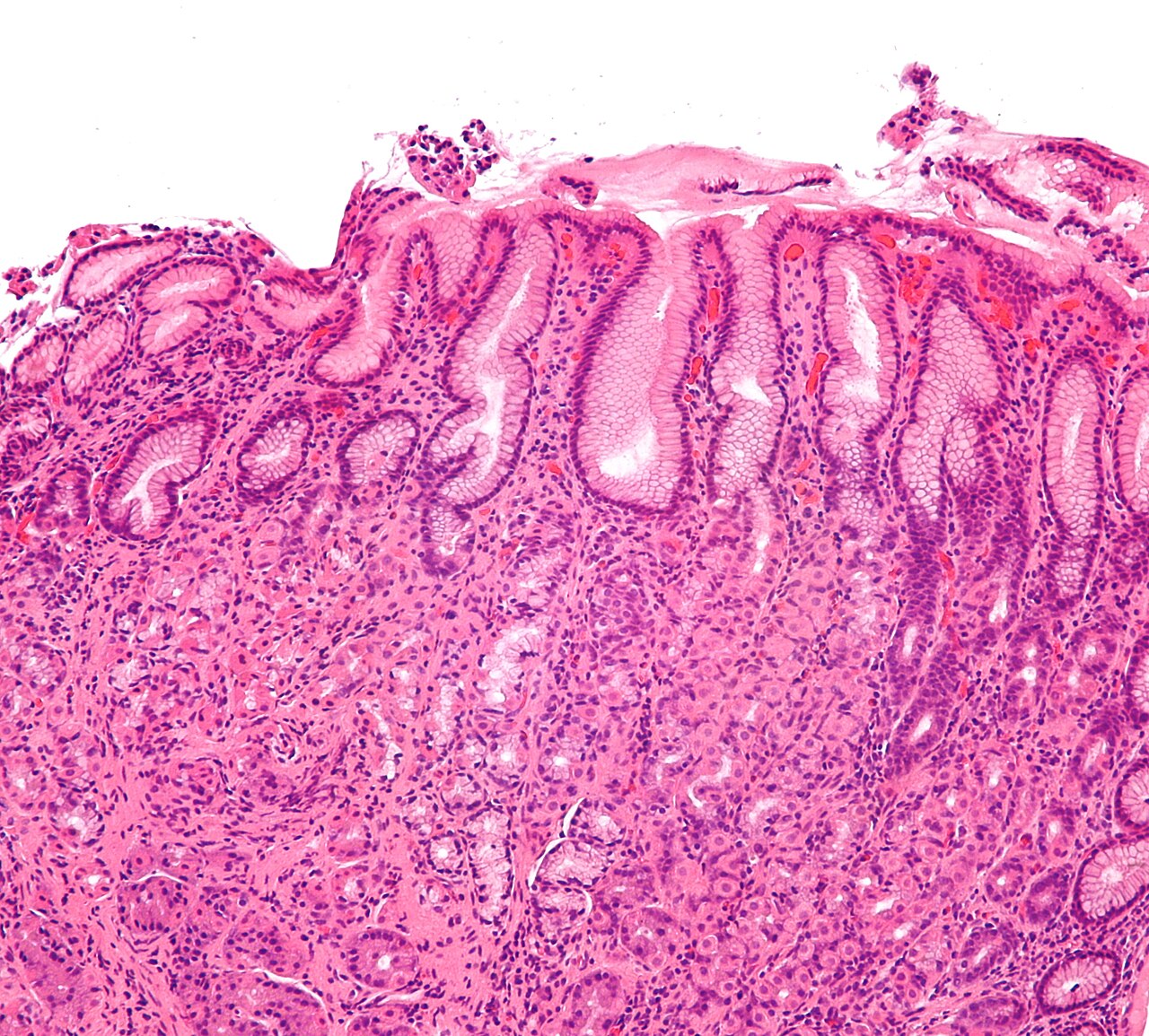 Histología gástrica con H. pylori