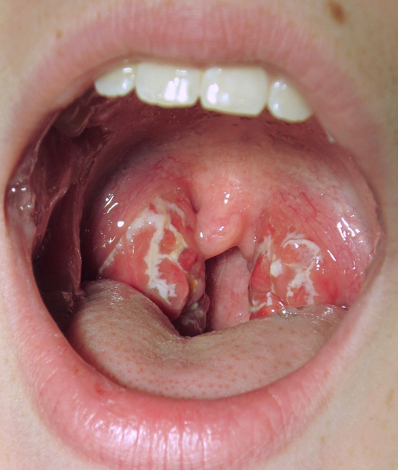 Garganta con faringitis